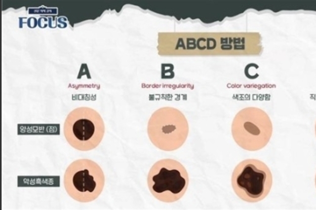 '점'인 줄 알았는데 '암'…알아두면 좋은 피부암 'ABCD룰'