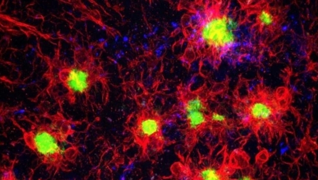 국립보건연구원 "한국인 치매 발병 관여하는 새 유전자 발견"