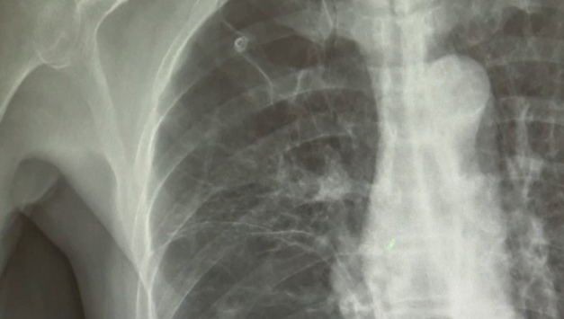 담배 안 피우는데 폐암?…"만성 폐질환 있으면 폐암 위험 3배"