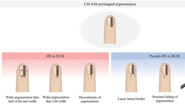 경북대병원 '손발톱 발생 흑색종 감별' 새 임상기준 제시
