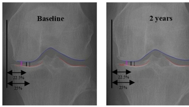 "AI로 무릎 골관절염 '최대 마모 지점' 정밀진단"