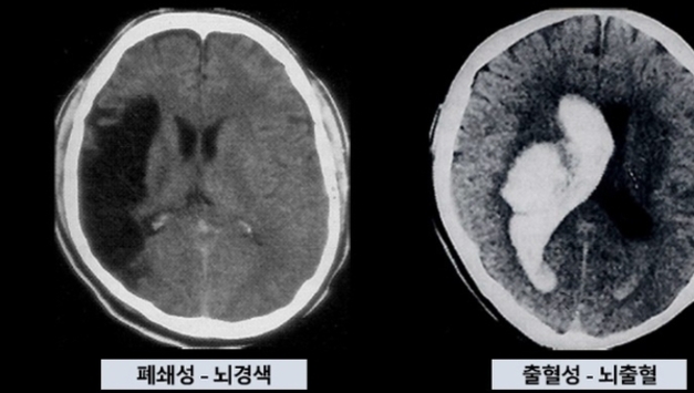 매번 MRI 찍는 대신…"간단 피검사로 뇌질환 경과확인 가능"