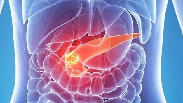 췌장암 간 전이, AI가 혈액 분석해 알려준다"