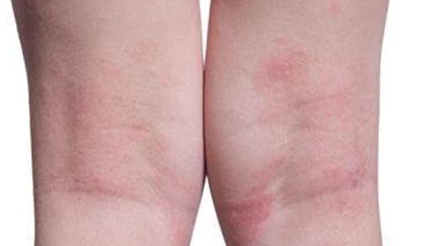 "아토피약, 얼마나 써야 할까"…수학으로 최적치료 입증