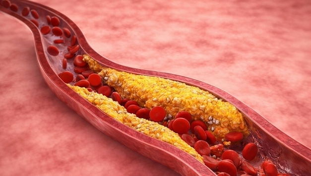 아이 콜레스테롤, 부모 닮는다…"'엄마 LDL' 더 중요"