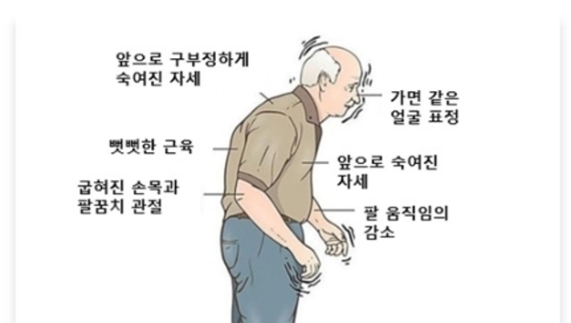 고령 부모님 변비·잠꼬대, 나이 탓 말고 파킨슨병 의심해야
