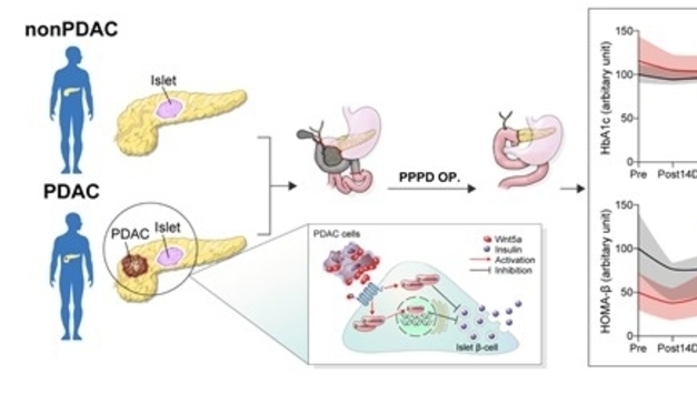갑작스러운 당뇨병, 췌장암 경고 신호일 수 있다