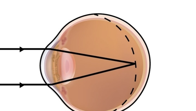 한국인 40세 이전 4명중 3명 '근시'…"미국 유병률의 2배"