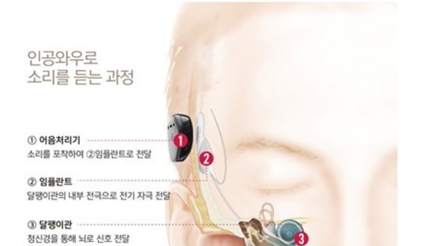 "아이 귀는 자라는데 인공와우 기기는 평생 그대로"