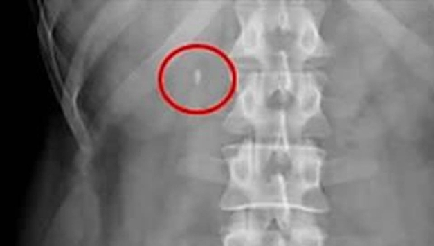 기온 오르고 활동 느는 봄철…옆구리 통증, 요로결석 신호일수도