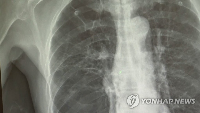 추가 검사 안해 발견 못한 폐암…"병원, 유족에 배상해야"