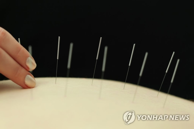 침술[게티이미지뱅크 제공]