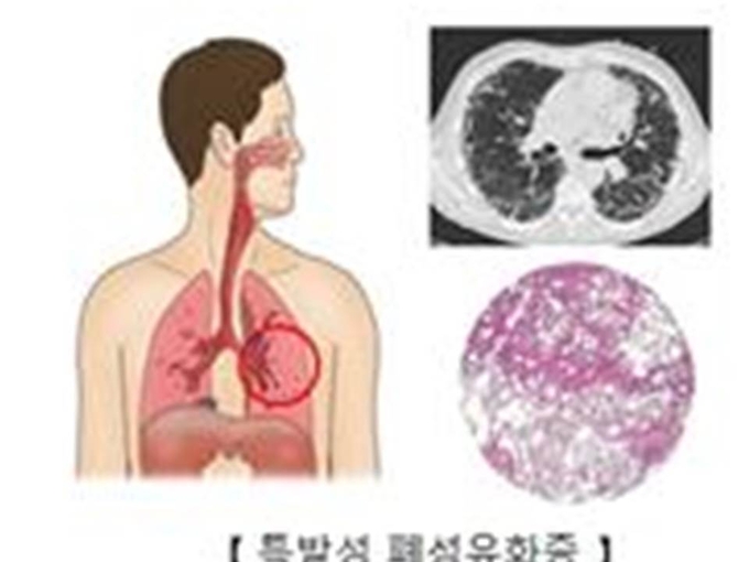 특발성 폐섬유화증<br>
[서울아산병원}