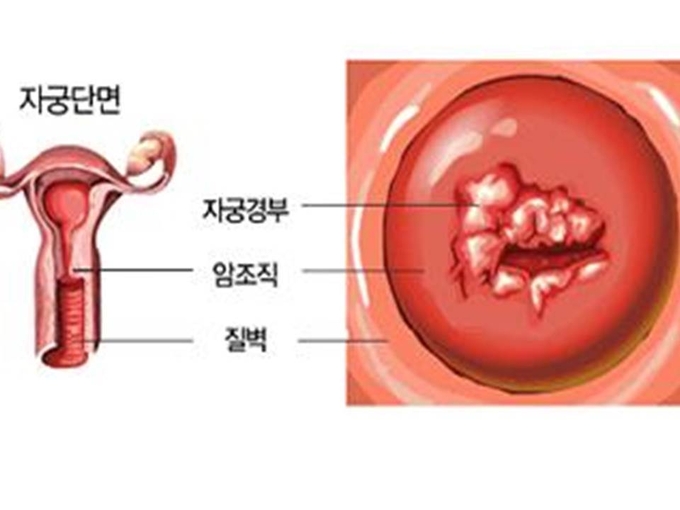 자궁경부암