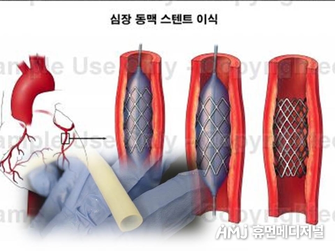 인공혈관(사진 합성)