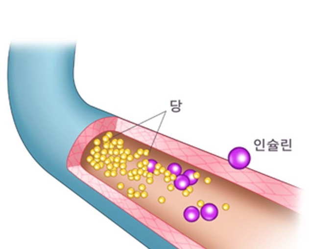 당뇨병