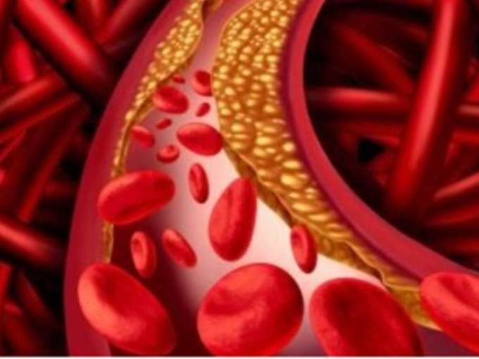 '나쁜' 콜레스테롤인 저밀도 지단백(LDL: low-density lipoprotein)