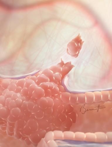 유방암 종양에서 분리되는 '순환 종양 세포' 클러스터 이미지<br>
[미국 존스홉킨스의대. 재판매 및 DB 금지]