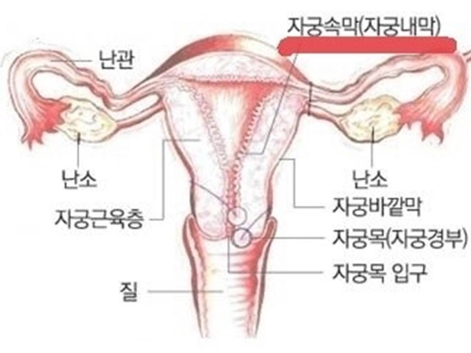자궁내막증