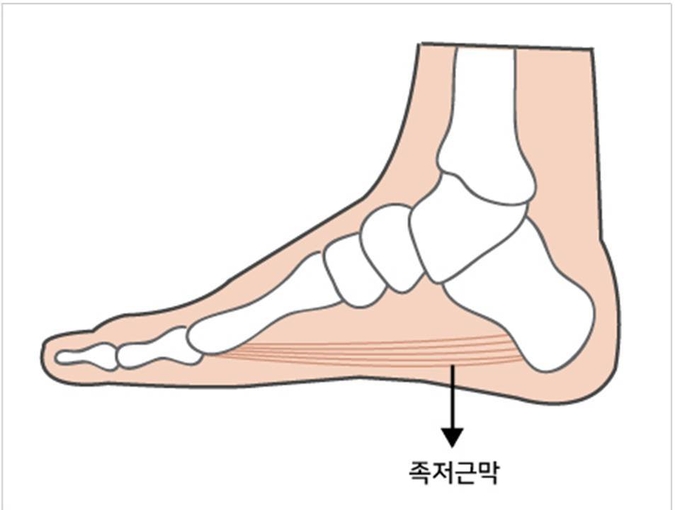 족저근막