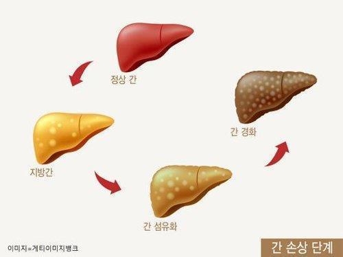 <strong>지방간과 간질환</strong>