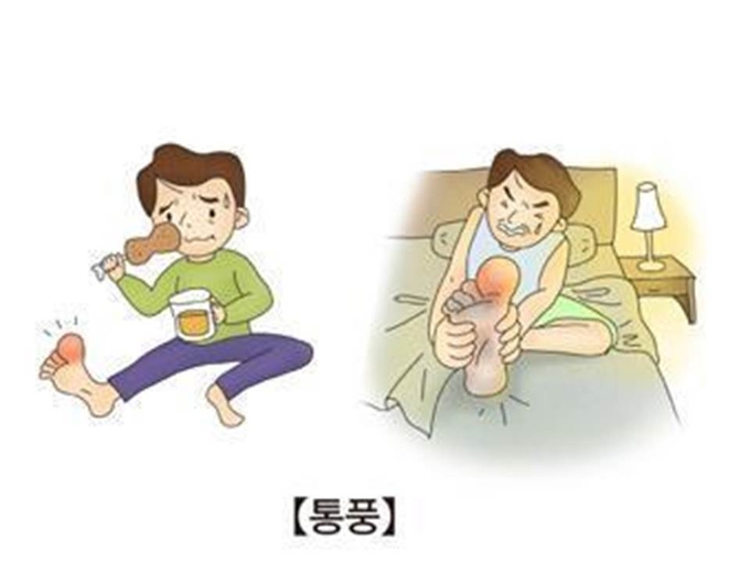 <strong>통풍</strong><br>
[출처: 서울아산병원}
