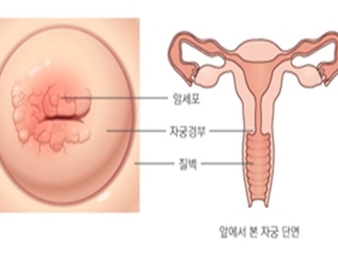  앞에서 본 자궁 단면
