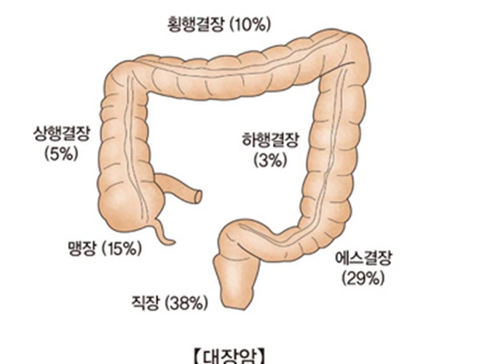 대장암