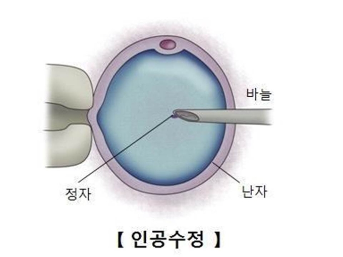 인공수정