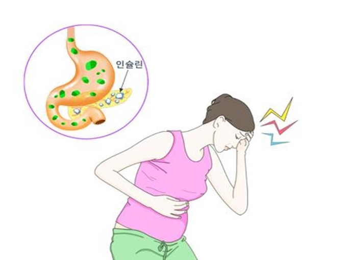임신성 당뇨